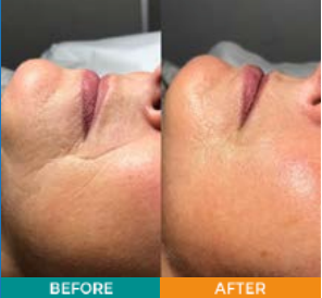 6 Treatment HA + VIT C Pack.