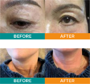 6 Treatment HA + VIT C Pack.